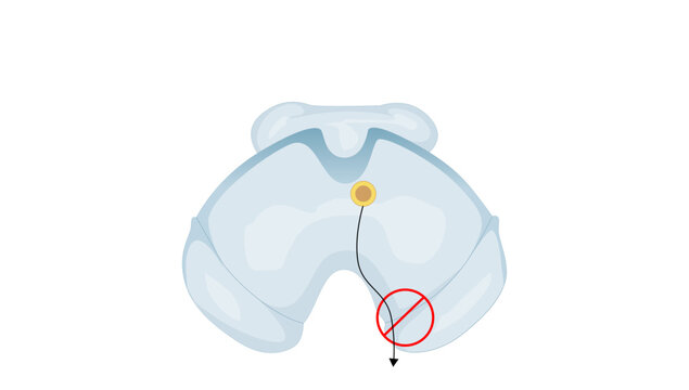 Weber syndrome, Illustration showing the midbrain lesion affecting the oculomotor nerve and cerebral peduncle in Weber syndrome.