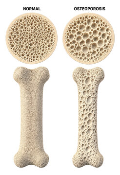 Comparison of Normal Bone and Bone with Osteoporosis Structure Close Up