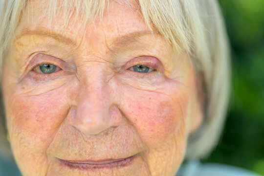 Senior Woman Eye Infection Closeup