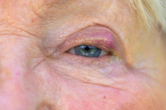 Senior Eye With Visible Stye