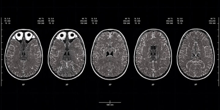 MRI Brain Scans Showing Axial Views Of Human Cerebral Structures