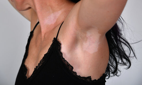 Nahaufnahme einer Frau mit hellen depigmentierten Hautstellen im Achsel- und Oberk&ouml;rperbereich. Vitiligo (Leucopathia acquisita), Pigmentst&ouml;rung, Dermatologie und Hautgesundheit.