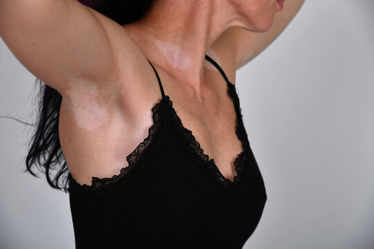 Nahaufnahme einer Frau mit hellen depigmentierten Hautstellen im Achsel- und Oberk&ouml;rperbereich. Vitiligo (Leucopathia acquisita), Pigmentst&ouml;rung, Dermatologie und Hautgesundheit.