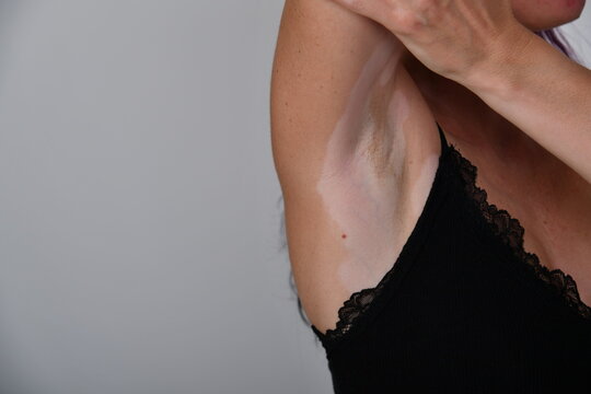 Nahaufnahme einer Frau mit hellen depigmentierten Hautstellen im Achsel- und Oberk&ouml;rperbereich. Vitiligo (Leucopathia acquisita), Pigmentst&ouml;rung, Dermatologie und Hautgesundheit.
