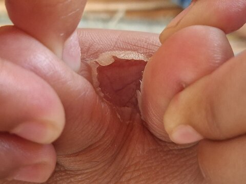 the folds between the toes peel due to athlete's foot, tinea pedis
