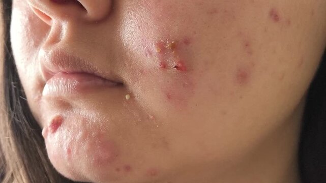 Close up of young woman with inflammatory acne and pus-filled pimples on her face, representing problem skin, adolescent acne, dermatology and skin care.