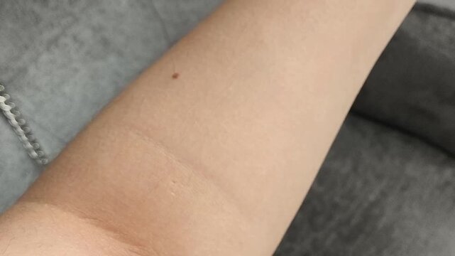 a hand with visible moles being examined, illustrating skin monitoring, dermatological examination, mole awareness and preventive skin care.