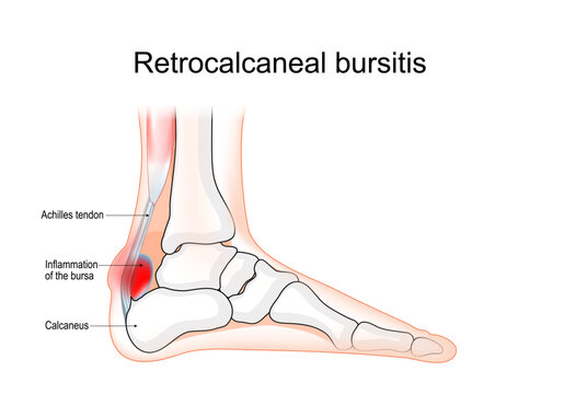 Retrocalcaneal bursitis. Heel anatomy and inflammation location. The ankle joint.