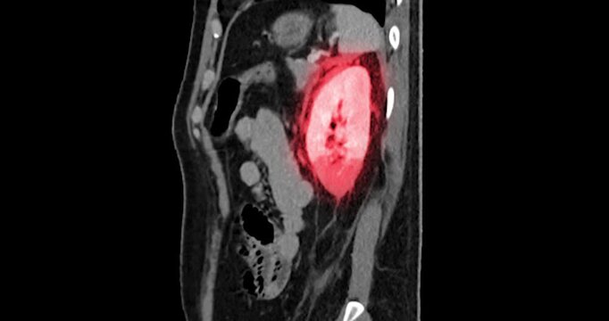 Sagittal CT scan zooms into the left flank with a red overlay highlighting the kidney injury. Left renal injury grade 4. Suggested left adrenal injury.