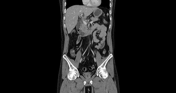Grayscale coronal CT scan zooms into the abdomen showing the traumatic kidney injury. Left renal injury grade 4. Suggested left adrenal injury.
