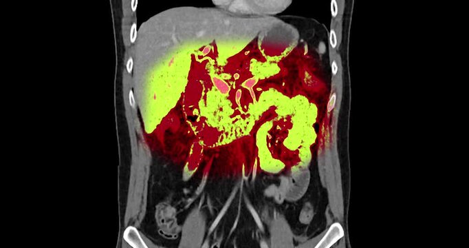 Coronal CT scan zooms in with a red yellow overlay highlighting the injured left kidney. Left renal injury grade 4. Suggested left adrenal injury.