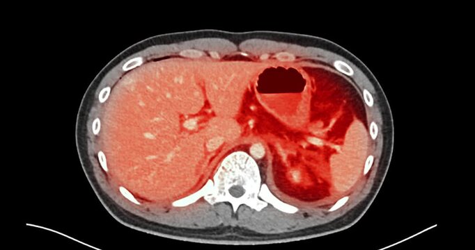 Axial CT scan scrolls through the abdomen and pelvis with a red overlay highlighting the kidney. Left renal injury grade 4. Suggested left adrenal injury.