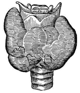 Vintage woodcut illustration of a goiter on the human neck