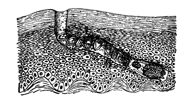 Vintage woodcut illustration of a scabies mite burrow