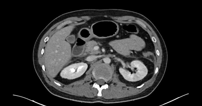 CT scan tours axial coronal and sagittal planes of the abdomen. Left renal injury grade 4. Suggested left adrenal injury.