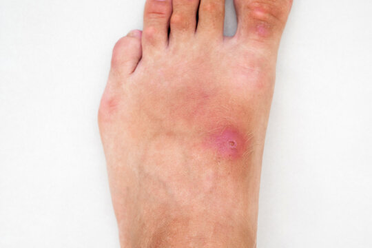 inflamed wound with a bacterial infection caused by an insect bite on a human foot. A red abscess with pus on the skin of leg closeup