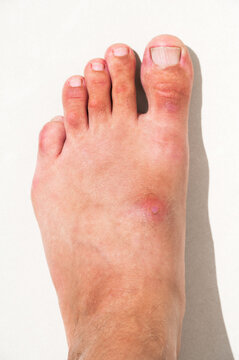 inflamed wound with a bacterial infection caused by an insect bite on human foot. A red abscess with pus on the skin