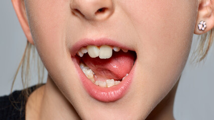 Playful child sticks out her tongue in neutral studio closeup with mischievous joy. Pediatric care,...