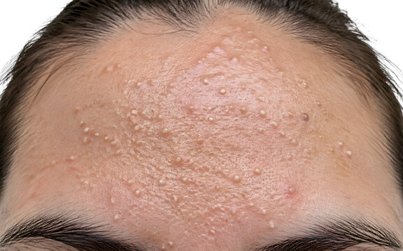 Forehead Fungal Acne and Closed Comedones Bumps Texture Skincare Problem