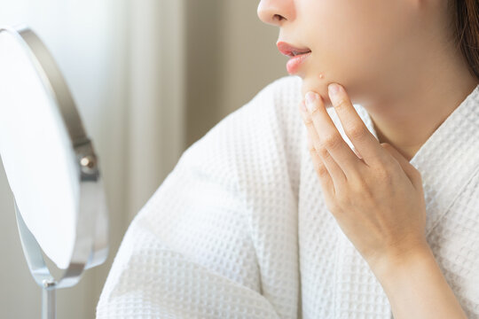 Expression worry asian young woman hand touching pustule around the chin and mouth, allergic when wear mask, makeup, show squeezing pimple spot from face. Beauty care, skin problem by acne treatment.