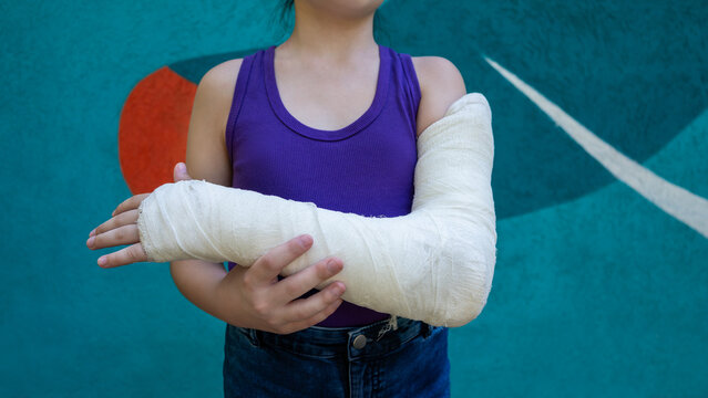Unrecognizable girl with bone fracture in full arm cast on colored background. Immobilization of elbow joint with splint.