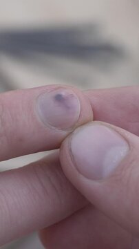 Close-up of workers injured finger with hematoma under nail. Bruise indicates forceful impact during manual task. Blurred hammer and nails in background highlight physical labor environment
