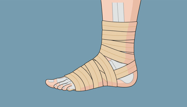 Human foot and ankle wrapped in a beige elastic medical bandage for injury support or rehabilitation on a blue background.