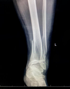 X-Ray of a male leg showing fractures of the tibia and fibula bones low down near the ankle