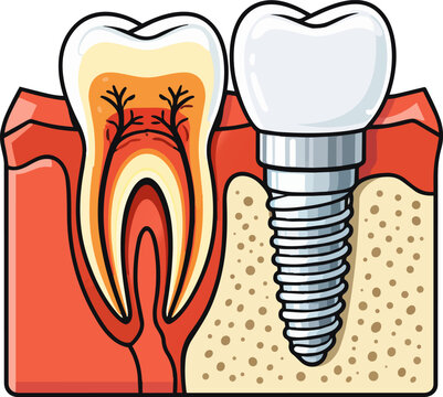 Cross section of a dental implant beside a natural tooth