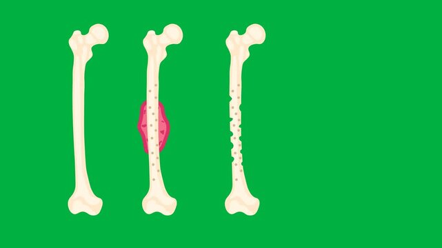 Medical vector animation displaying progressive femur tumor stages from localized growth to cortical destruction, highlighting osteosarcoma, chondrosarcoma, multiple myeloma, bone metastases