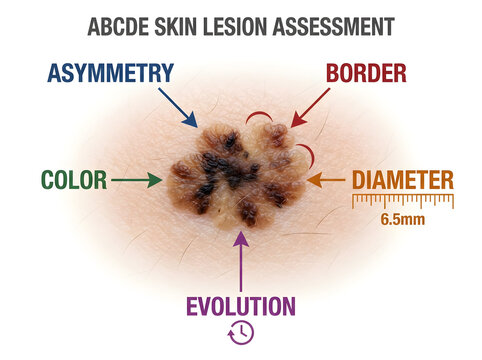 Abcde skin lesion assessment diagram for mole check isolated on white background