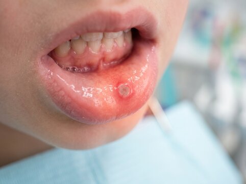 Close-up View of a Painful Aphthous Ulcer or Canker Sore on the Inside of a Human Lower Lip Indicating Oral Health Issues