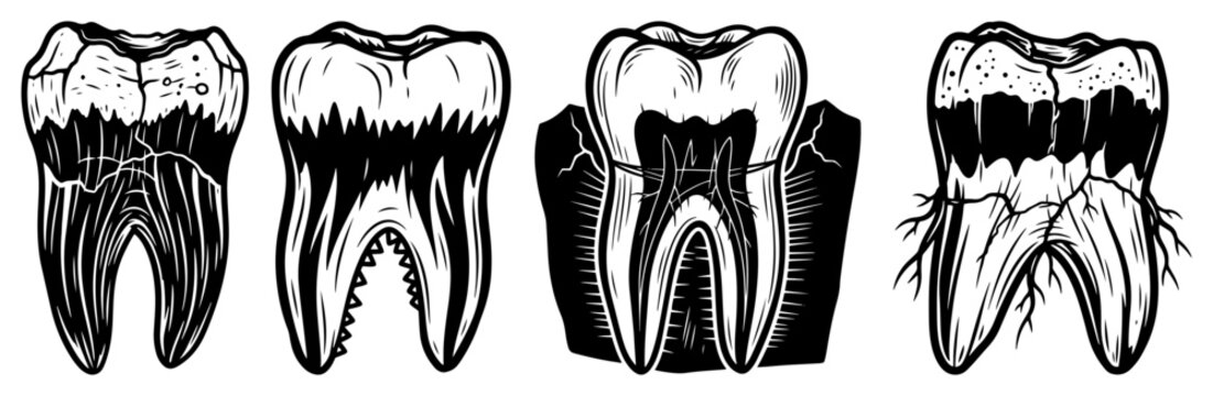 Human tooth anatomy and tooth decay vector illustration, dental root canal molar cross section isolated on white