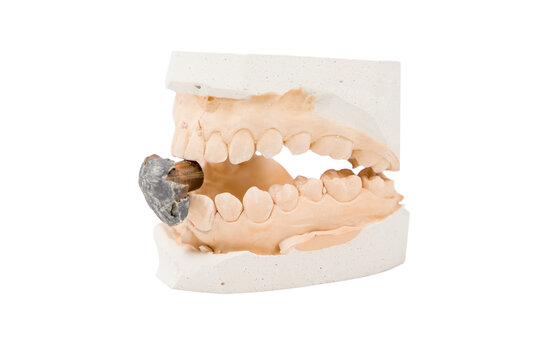 Dental jaw model with an exploded bullet, isolated on a white background.