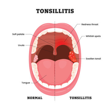 Tonsillitis labeled diagram, educational medical poster design healthcare scheme, normal versus inflamed tonsil comparison. Labeled swollen tonsil, whitish spots, throat redness, uvula