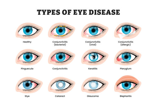 Eye diseases types labeled diagram, educational medical poster design healthcare, bacterial viral allergic conjunctivitis, keratitis, pterygium, cataract, glaucoma. Pinguecula, stye, blepharitis