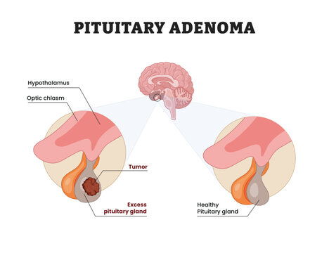 Pituitary adenoma labeled diagram, educational medical poster design healthcare scheme, pituitary gland tumor comparison. Labeled hypothalamus, optic chiasm, tumor and excess pituitary gland