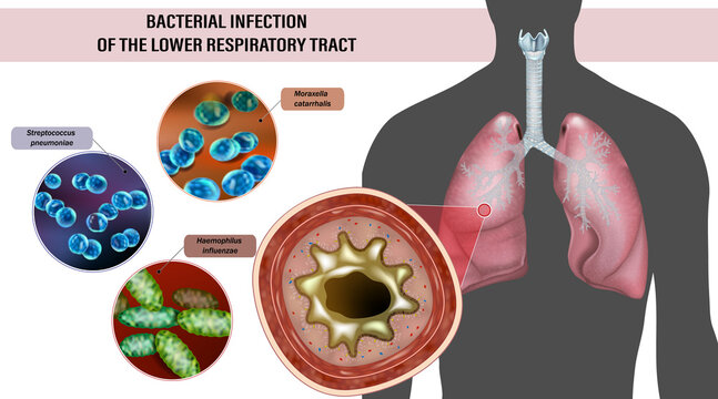 Bacterial Infection of Lower Respiratory Tract with Common Pathogens, Detailed Medical Illustration. Lower Respiratory Tract Bacterial Infection with Streptococcus, Haemophilus and Moraxella, Medical 