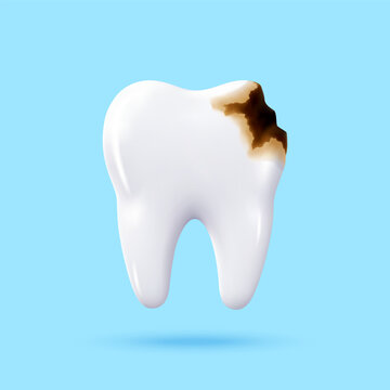 3d realistic tooth with brown caries decay on blue background. Damaged molar with cavity illustrates dental disease and oral hygiene problems.