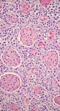 Histologic hepatic transformation: liver ailment, virus hepatitis, cell inflammation, fibrosis process, hepatocyte damage, steatosis lesion, cirrhosis impact, Oncology insight.