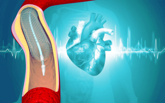 Medical illustration of heart anatomy showing coronary artery angioplasty and balloon stent implantation.