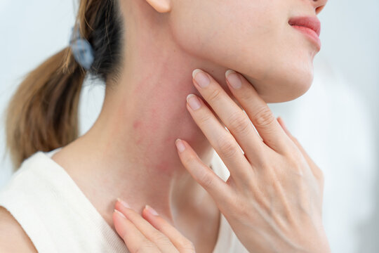 skin problem and beauty. woman scratch body has itchy skin from skin allergic, steroid allergy, sensitive skin, red from sunburn, chemical allergy, rash, insect bites, Seborrheic Dermatitis.