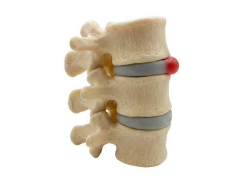 Lumbar spine model showing herniated disc pathology isolated on transparent background