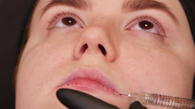 Woman receiving lip filler injection, cosmetologist using syringe to enhance lip volume and shape. Professional aesthetic treatment focused on facial appearance and lip contour