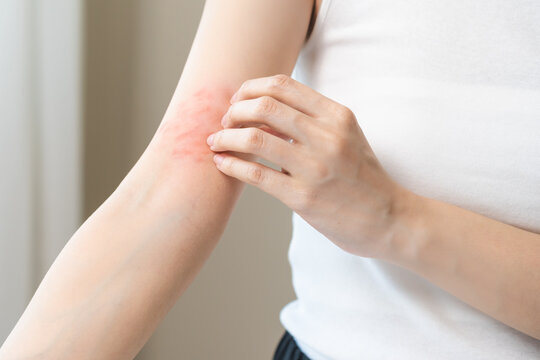 Dermatology asian young woman, girl allergy, allergic reaction from atopic, insect bites on her arm, hand in scratching itchy, itch red spot or rash of skin. Healthcare, treatment of beauty.