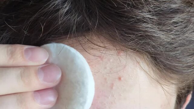 Forehead skin cleansing with cotton pad removing acne