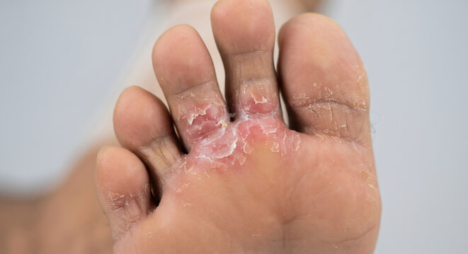 Athlete's Foot Close-up: A detailed view of toes affected by a fungal infection, showing scaling, redness, and discomfort. This image highlights a common dermatological issue.