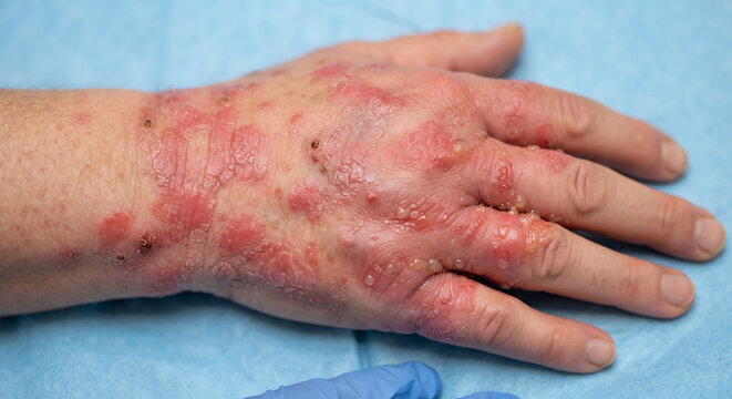 Dermatological Concern: Close-up of a hand afflicted with a severe skin rash, exhibiting redness, inflammation, and irritation.