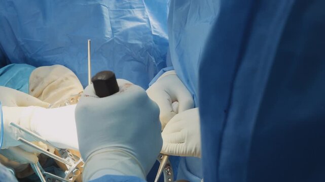 Close-up of surgical team adjusting circular frame fixator during complex bone reconstruction surgery