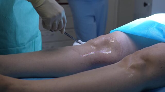 Medical professional in surgical gloves using forceps and a sterile pad to apply disinfectant to a patient's knee, preparing the skin for a medical procedure in a modern operating room